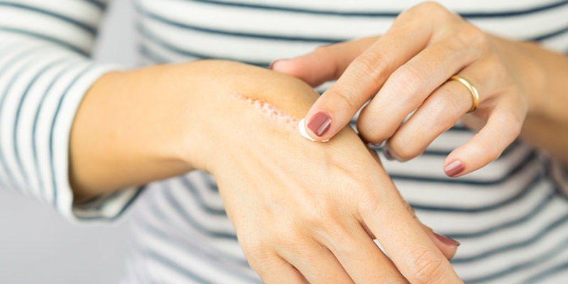 Se Br&ucirc;ler Ou Attraper Le Clou &Agrave; Mains Nues