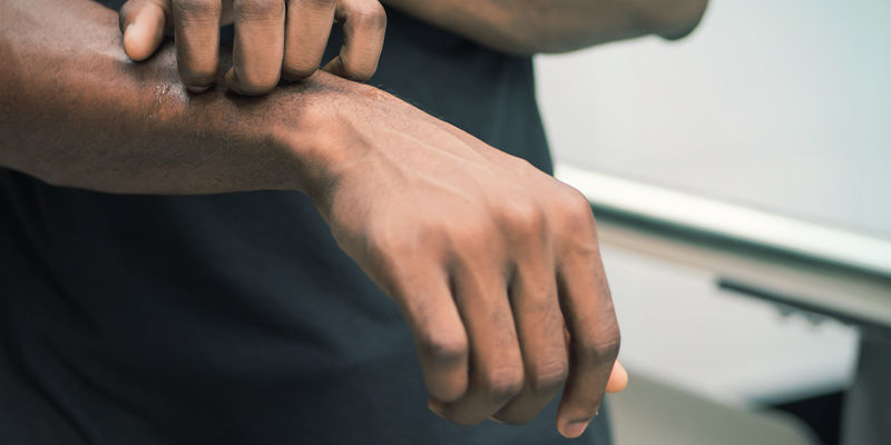 Př&iacute;znaky alergie na konop&iacute;