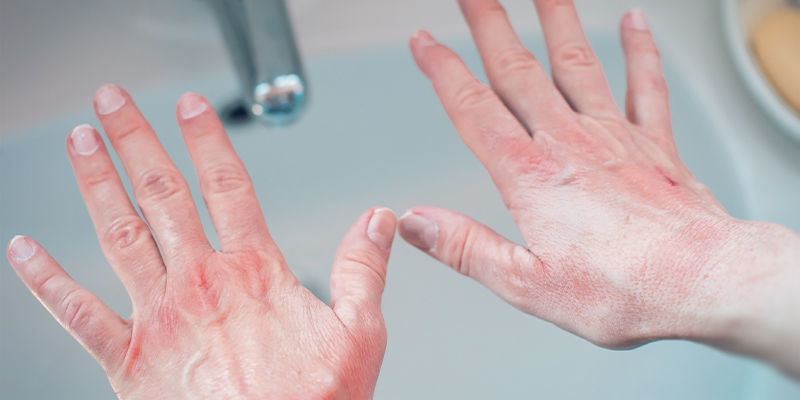 Jak zastavit p&aacute;len&iacute; kůže od p&aacute;liv&yacute;ch papriček?